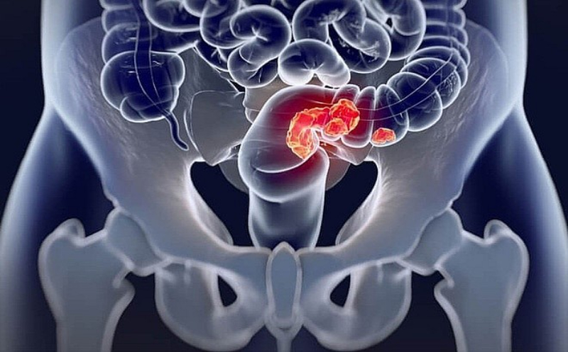 Hình ảnh ung thư đại tràng