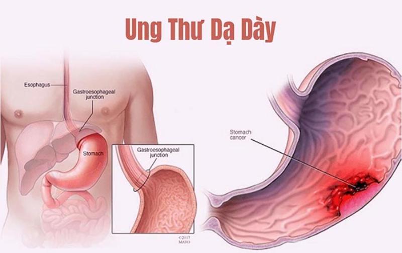 Bệnh ung thư dạ dày là gì