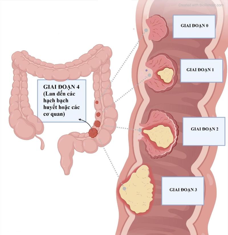 Các giai đoạn ung thư đại trực tràng