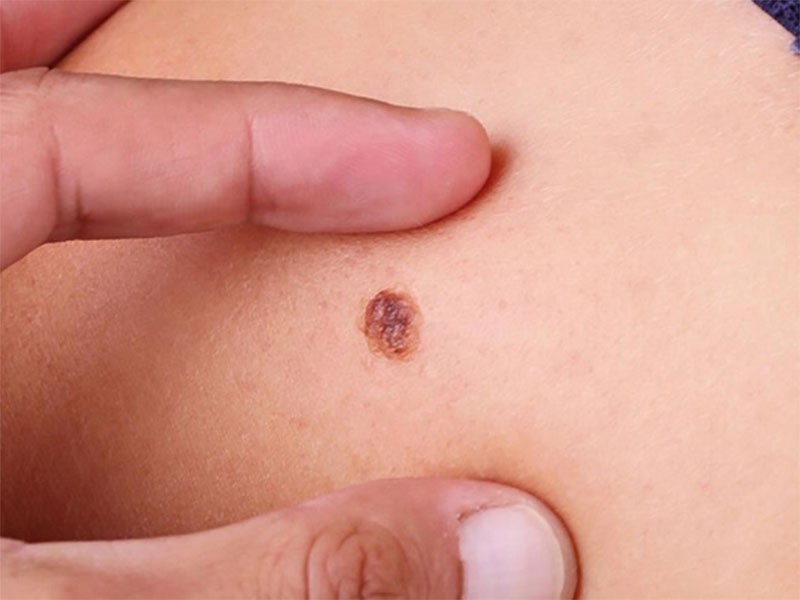 Căn bệnh ung thư da giai đoạn đầu