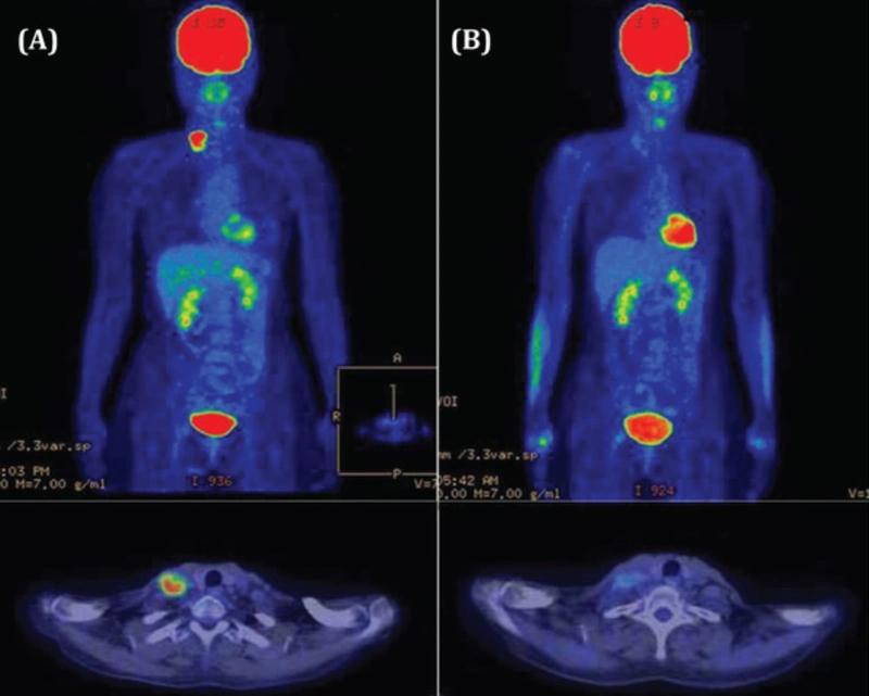 Chụp PET scan