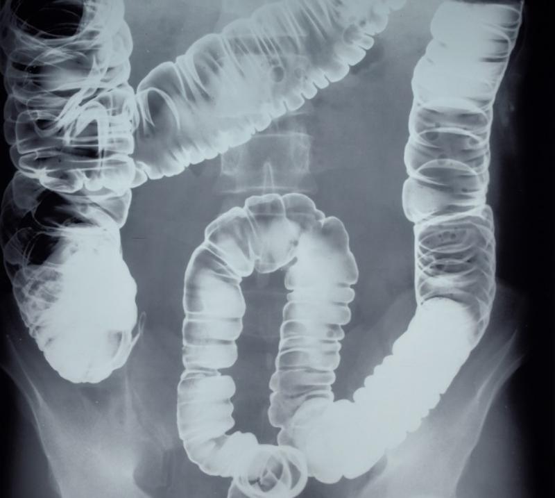 Chụp Xquang đại tràng