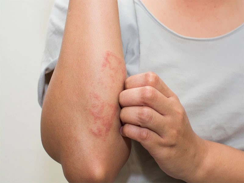 Dấu hiệu của bệnh ung thư da giai đoạn đầu