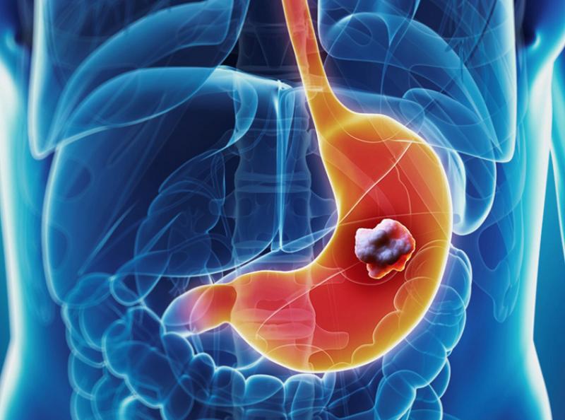 Sơ lược về bệnh ung thư dạ dày