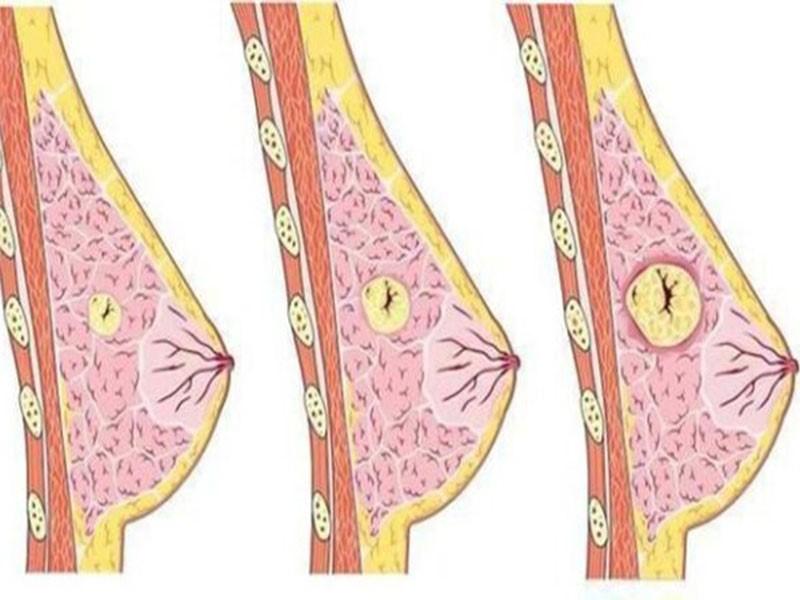 Triệu chứng của u xơ tuyến vú