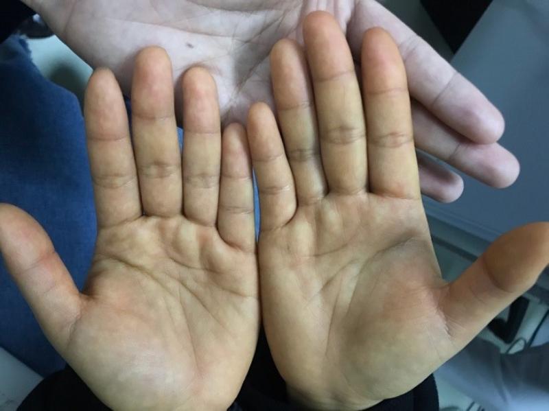 Triệu chứng ung thư gan giai đoạn đầu