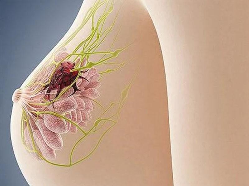 U xơ tuyến vú lành tính