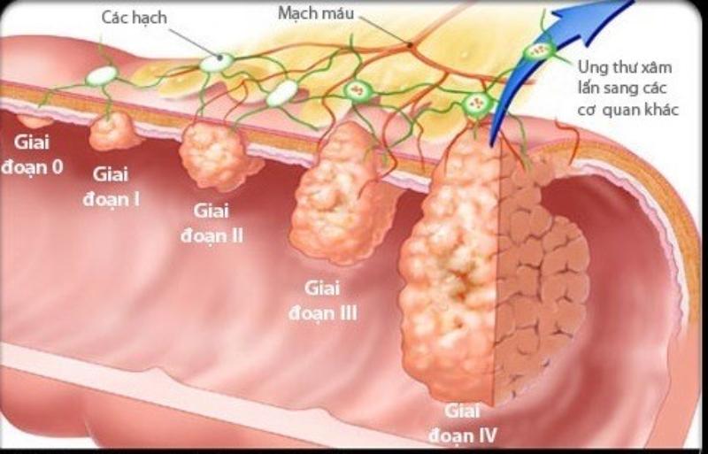 Ung thư dạ dày giai đoạn cuối là gì?