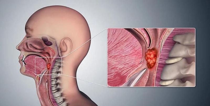 Ung thư vòm họng giai đoạn 2