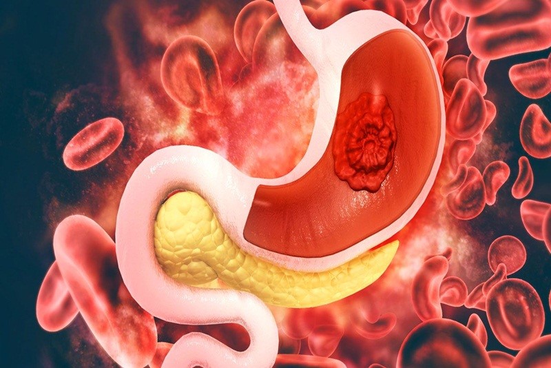 Dấu hiệu cảnh báo nguy cơ ung thư dạ dày