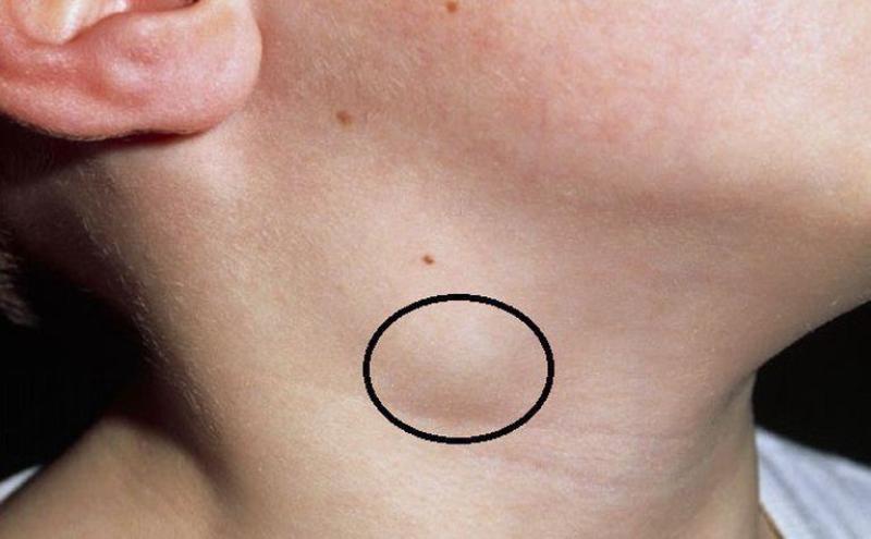 thông tin chung về bệnh ung thư vòm họng