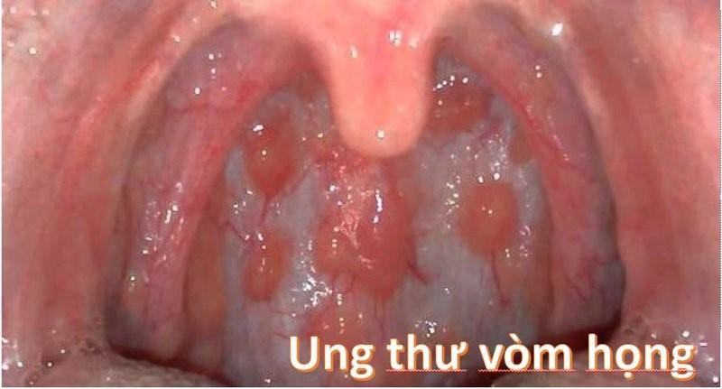 Triệu chứng và dấu hiệu ung thư vòm họng ở nữ giới