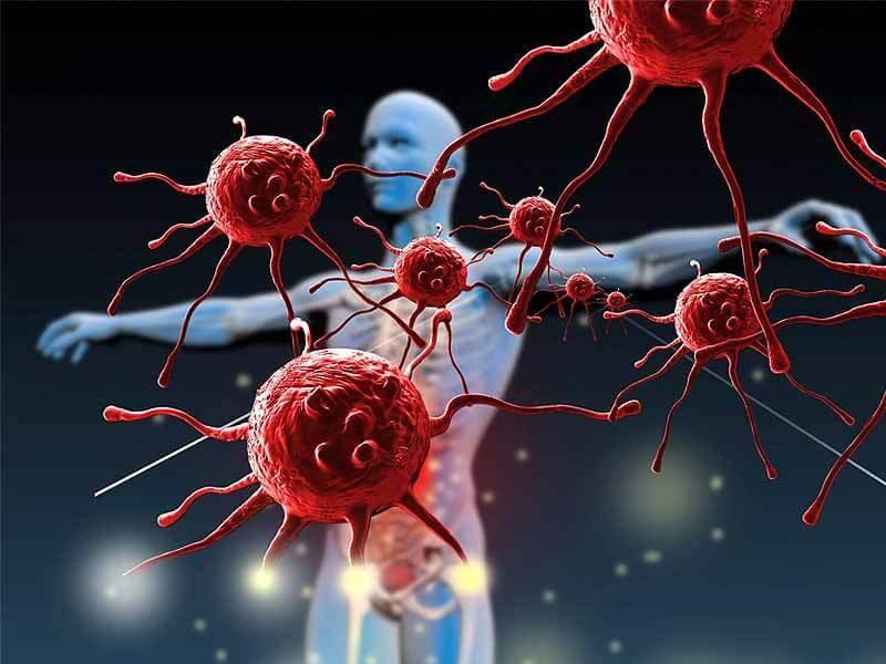 Các phương pháp điều trị ung thư vòm họng giai đoạn 2