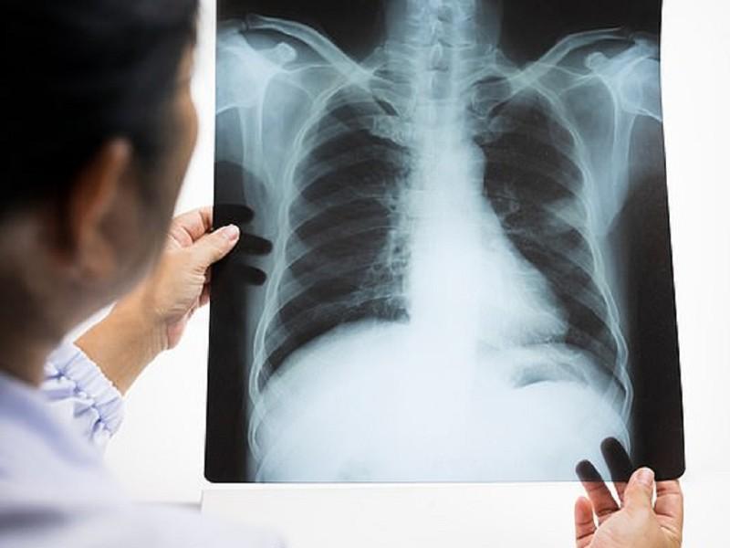 Cách chẩn đoán ung thư phổi tế bào nhỏ