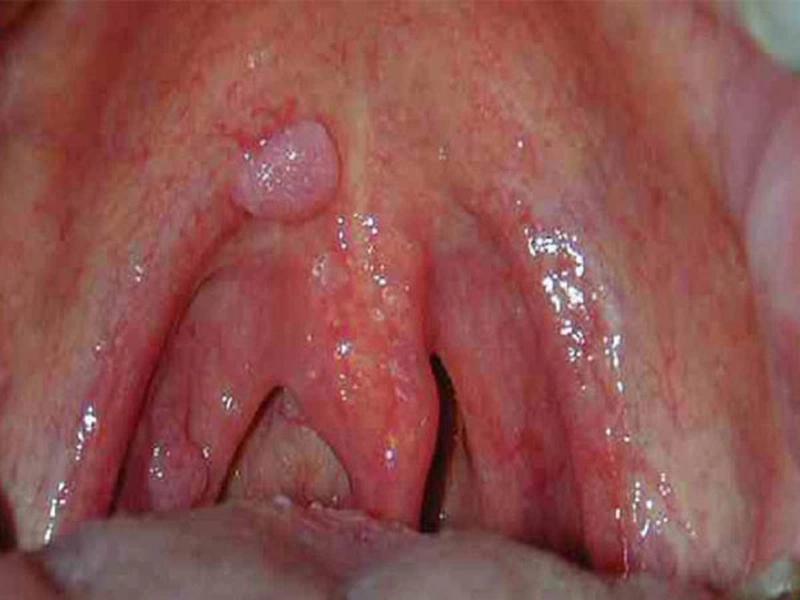 Căn bệnh ung thư vòm họng ở giai đoạn đầu