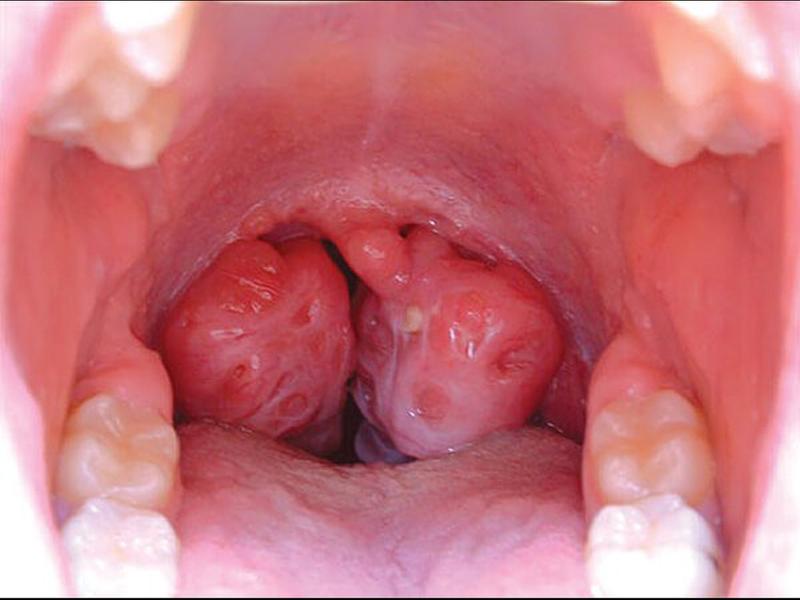 Căn bệnh ung thư vòm họng ở trẻ em