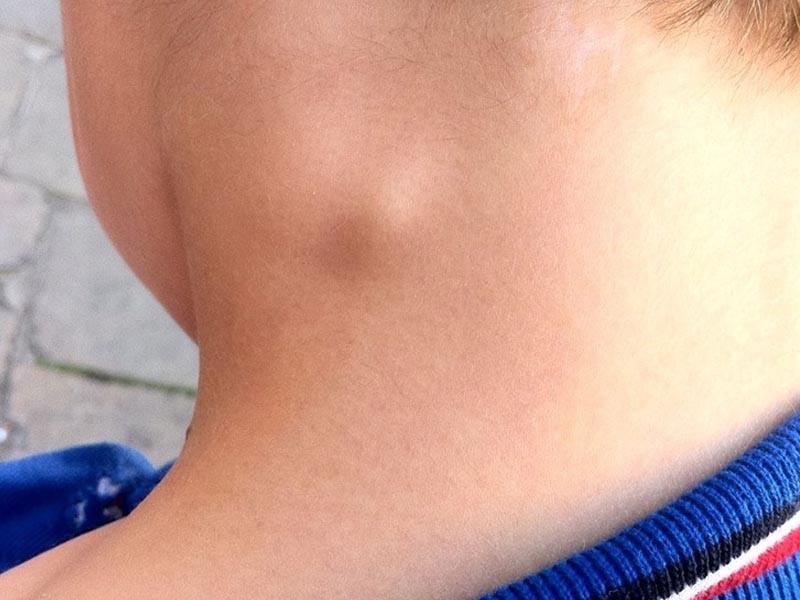 Cổ của bé có thể xuất hiện hạch