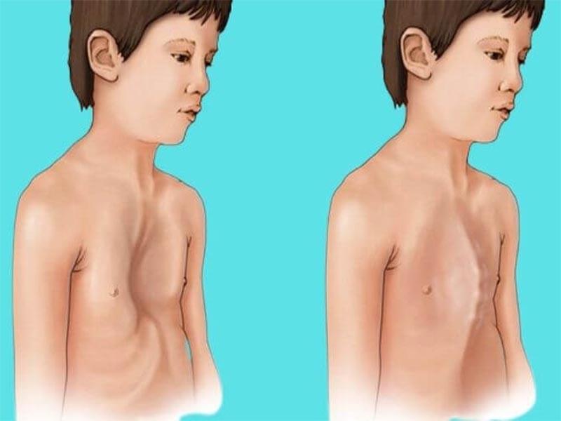 Dấu hiệu ung thư tuyến giáp thể tủy