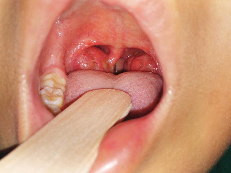 Tự kiểm tra ung thư vòm họng