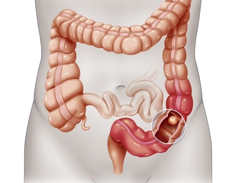 Điều trị ung thư trực tràng giai đoạn 4