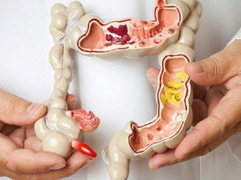 Tiên lượng sống của bệnh nhân ung thư trực tràng giai đoạn 3