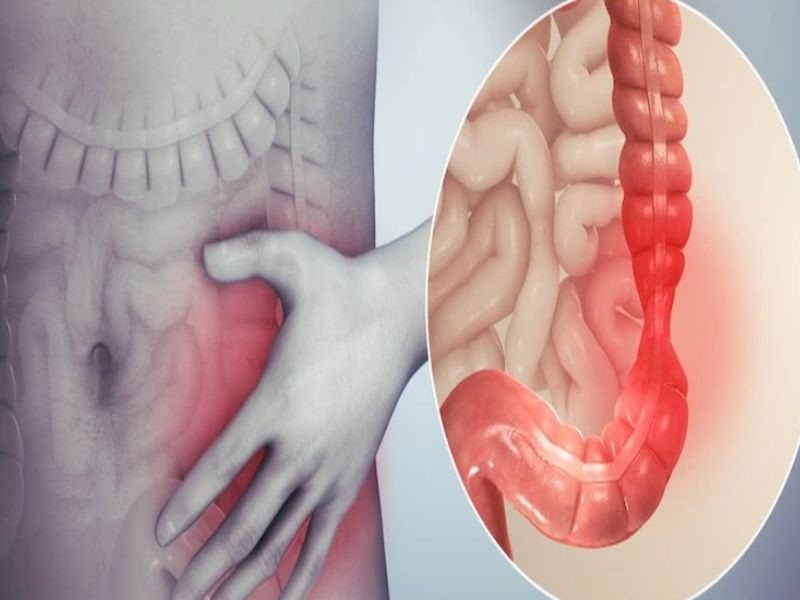 Ung thư trực tràng giai đoạn 3