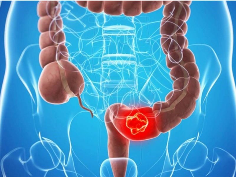 Ung thư trực tràng giai đoạn 4 sống được bao lâu?