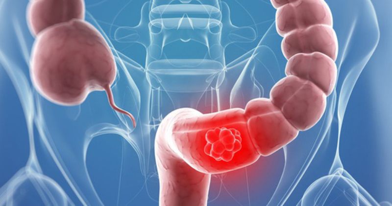 Ung thư trực tràng sống được bao lâu?