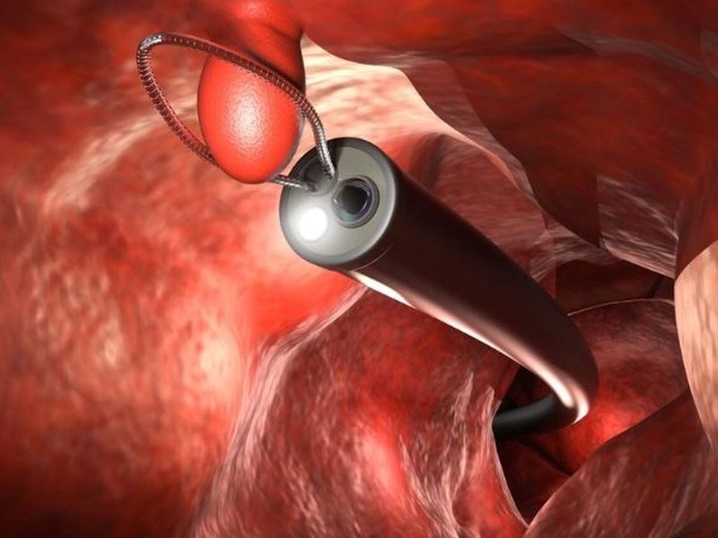 Ung thư trực tràng sống được bao lâu?