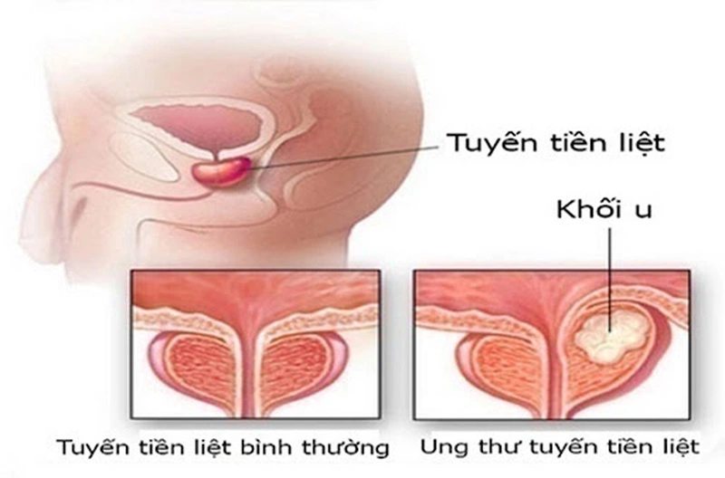 Ung thư tuyến tiền liệt là căn bệnh phổ biến ở nam giới