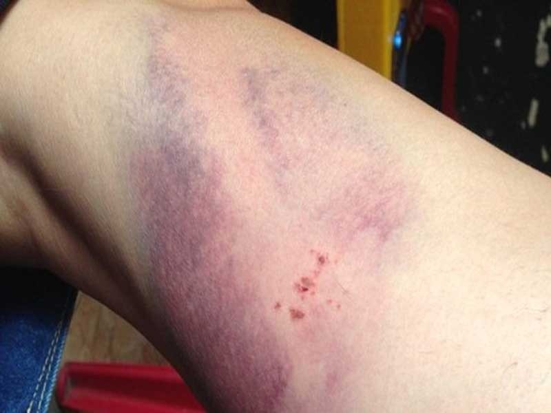 Bầm tím người không rõ nguyên nhân