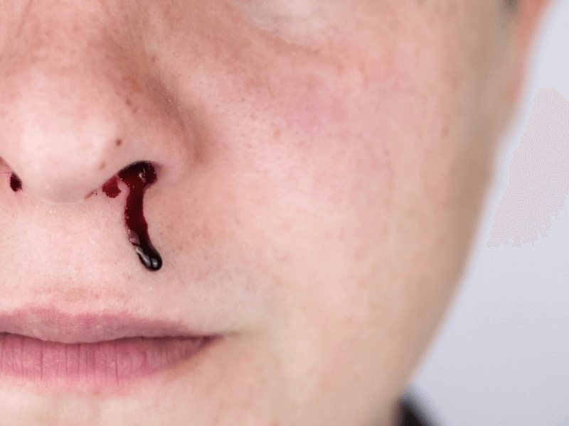 Bệnh nhân thường bị chảy máu cam