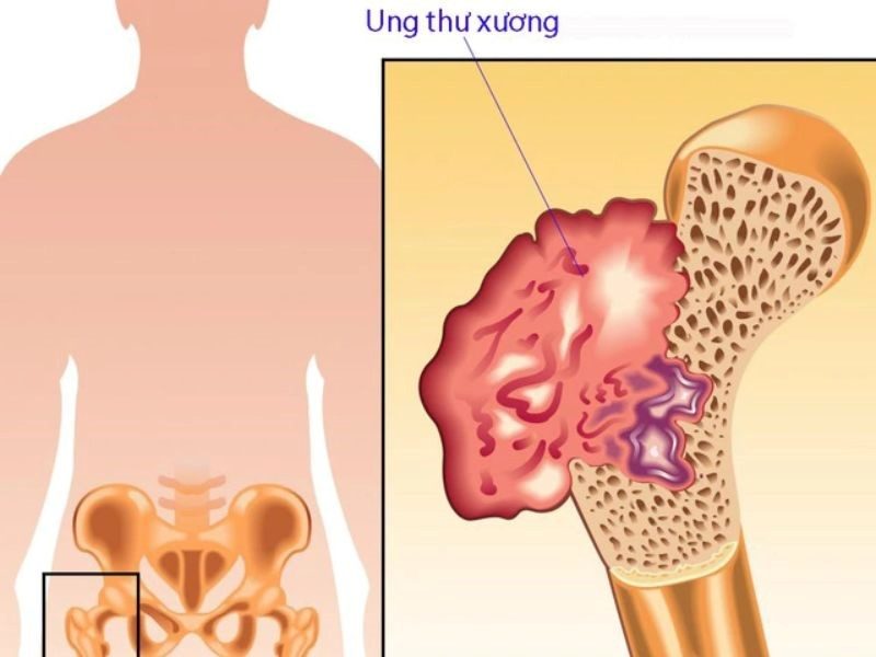 Bệnh ung thư xương là gì?