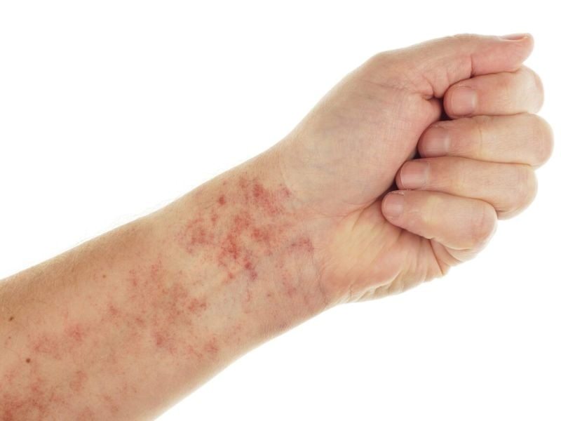 Các loại ung thư máu phổ biến hiện nay