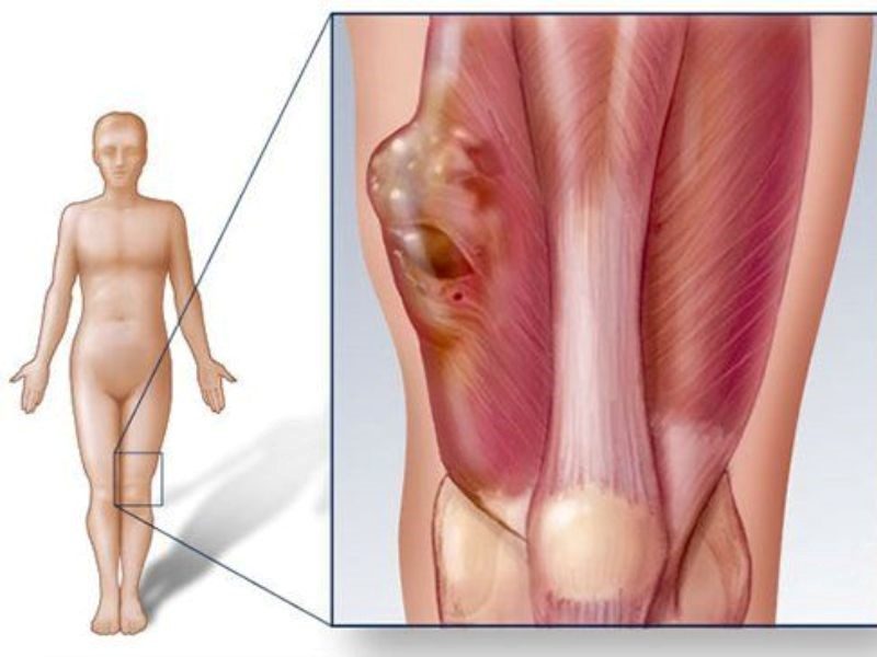 Các phương pháp điều trị ung thư xương