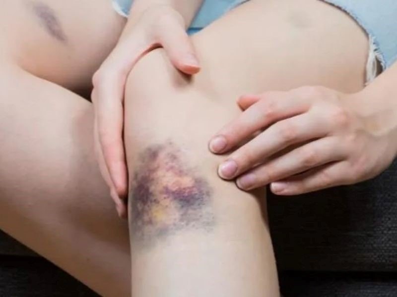 Cách chăm sóc cho bệnh nhân ung thư máu