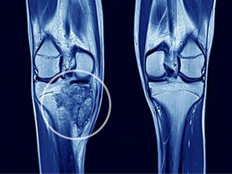 Căn bệnh ung thư xương