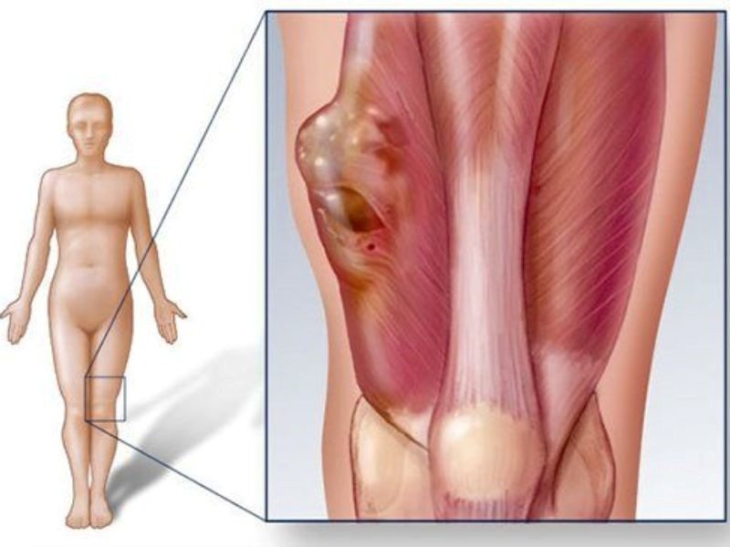 Căn bệnh ung thư xương rất nguy hiểm