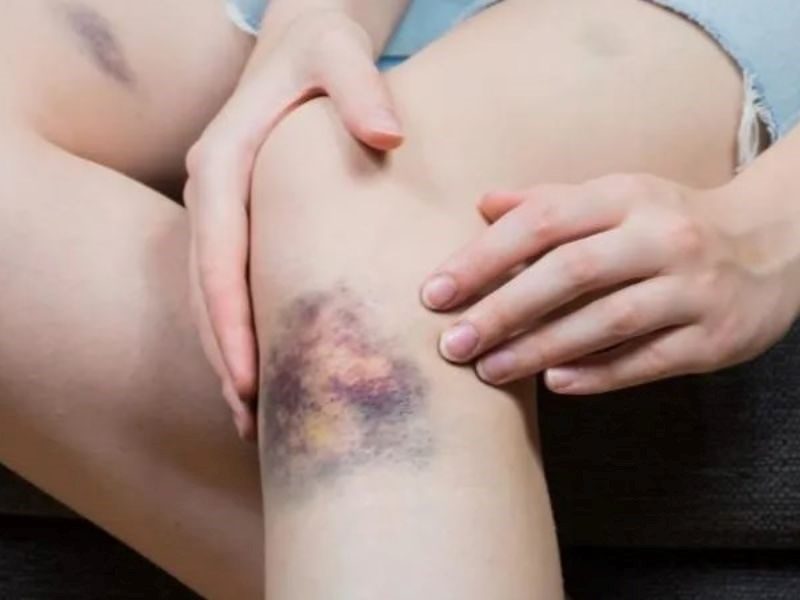 Dấu hiệu của bệnh ung thư máu