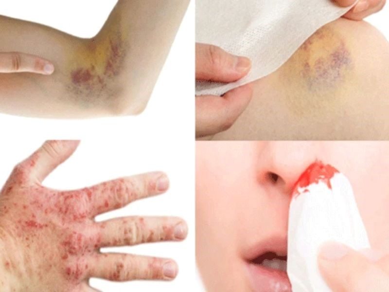 Dấu hiệu của căn bệnh ung thư máu