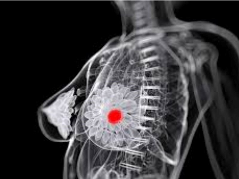 Dấu hiệu của căn bệnh ung thư vú di căn xương