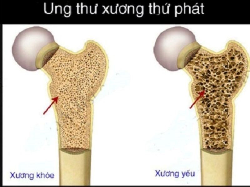 Dấu hiệu của căn bệnh ung thư xương