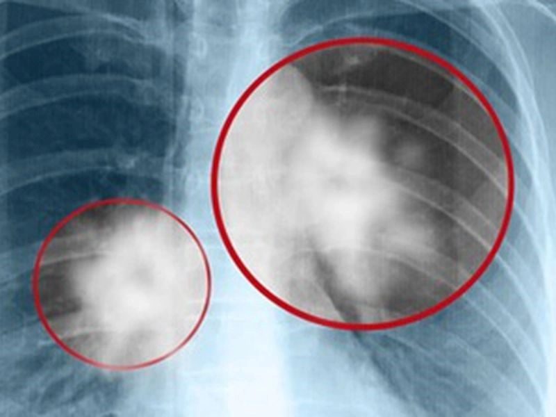 Dấu hiệu ung thư di căn xương