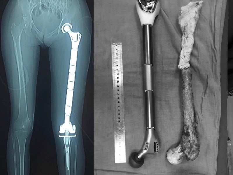 Nguyên nhân gây nên căn bệnh ung thư xương