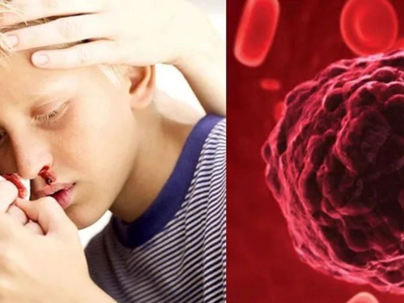 Nguyên nhân gây ra bệnh máu trắng
