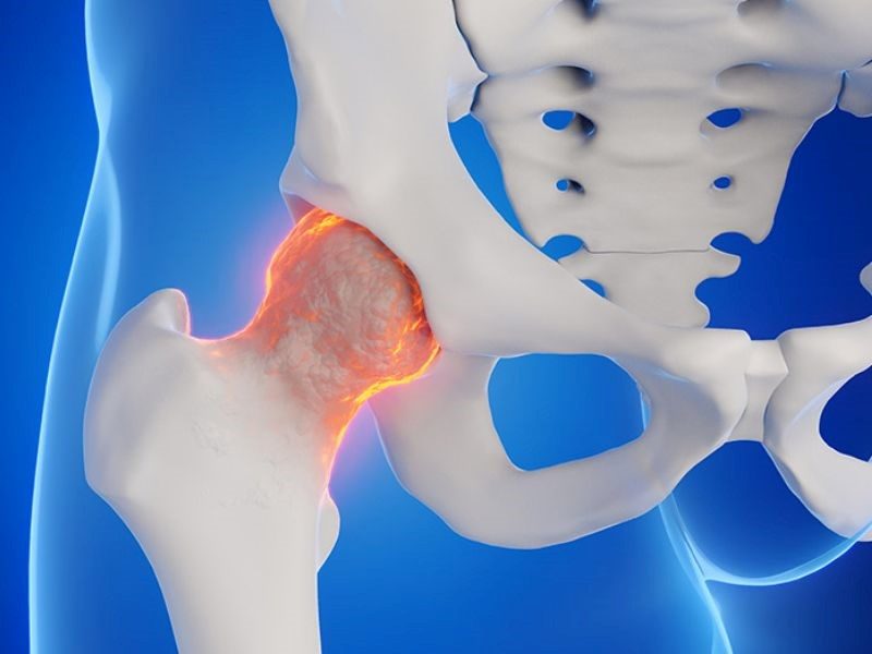 Nguyên nhân ung thư di căn xương