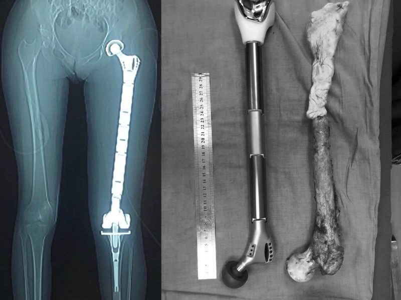 Phương pháp chẩn đoán căn bệnh ung thư xương