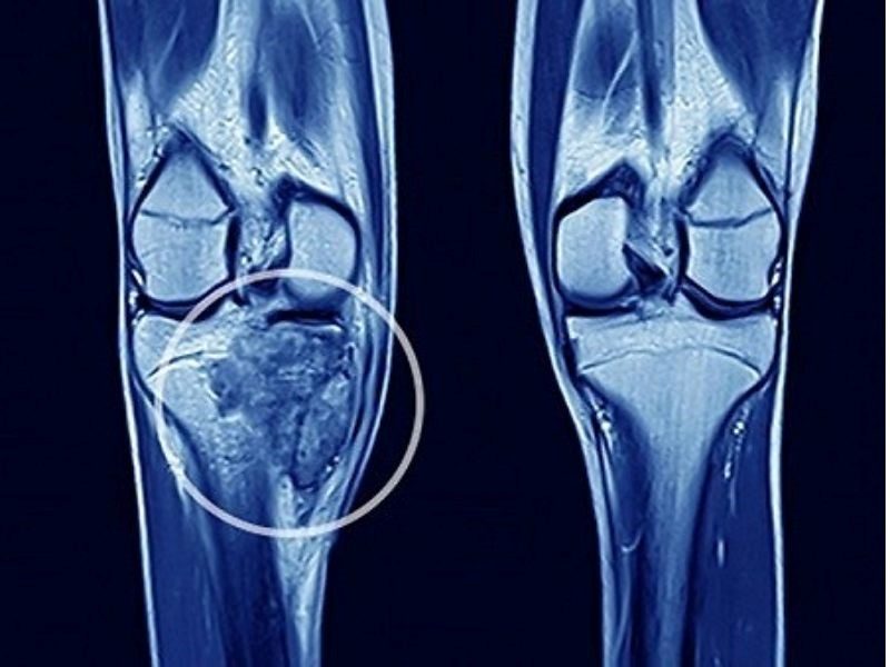 Ung thư di căn xương