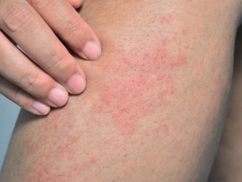 Ung thư máu có yếu tố di truyền nhưng rất ít