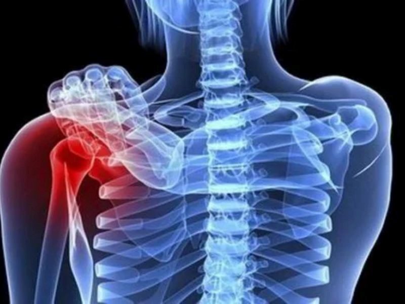 Ung thư vú di căn xương sống được bao lâu?